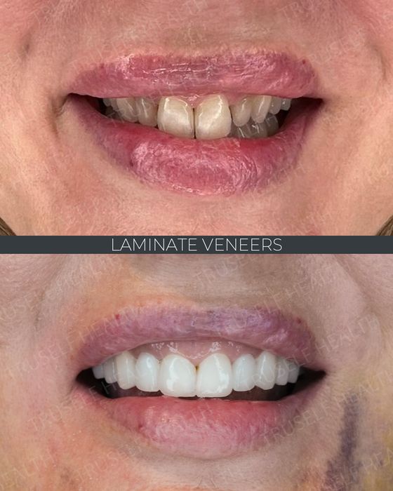 Smile Design before and after