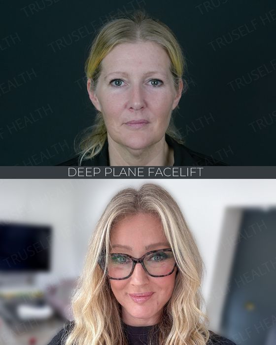 Facial Rejuvenation before and after