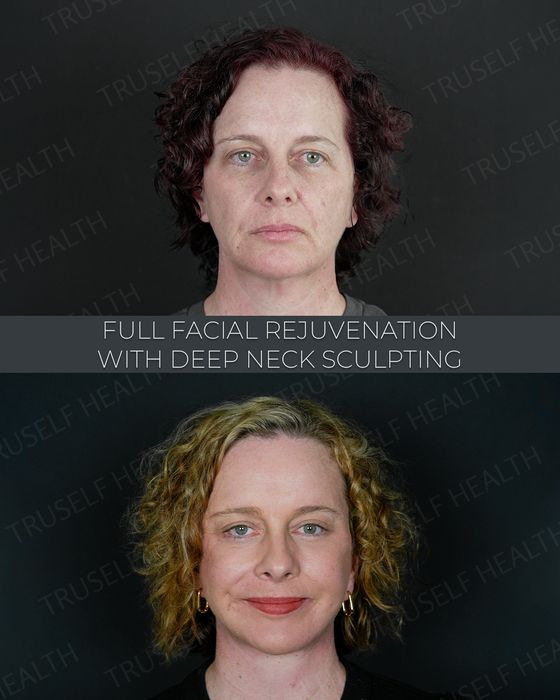 Facial Rejuvenation before and after