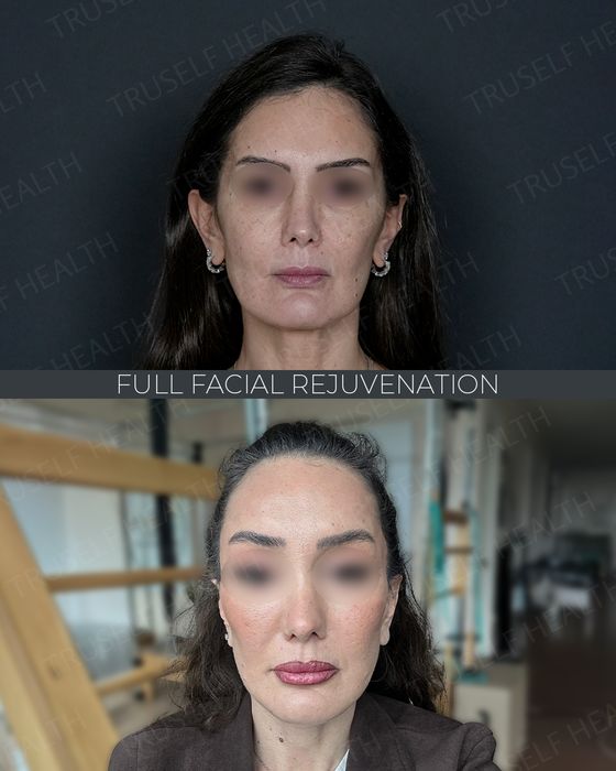 Facial Rejuvenation before and after