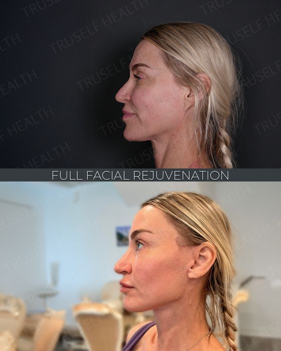 Facial Rejuvenation before and after