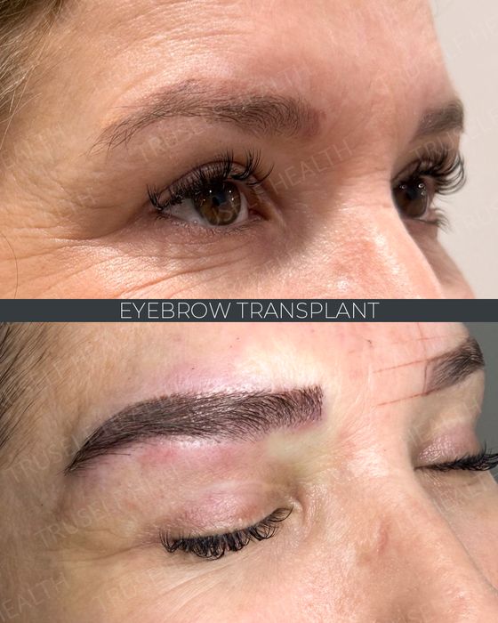 Hair Transplant before and after