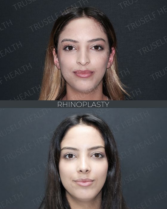 Facial Rejuvenation before and after