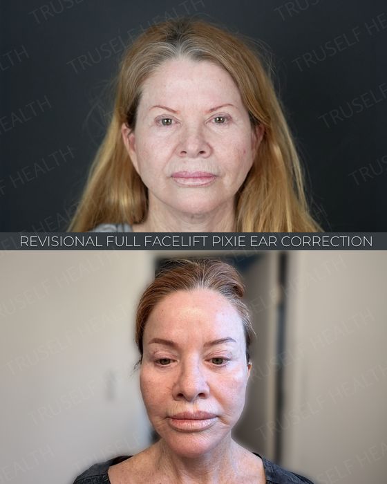 Facial Rejuvenation before and after