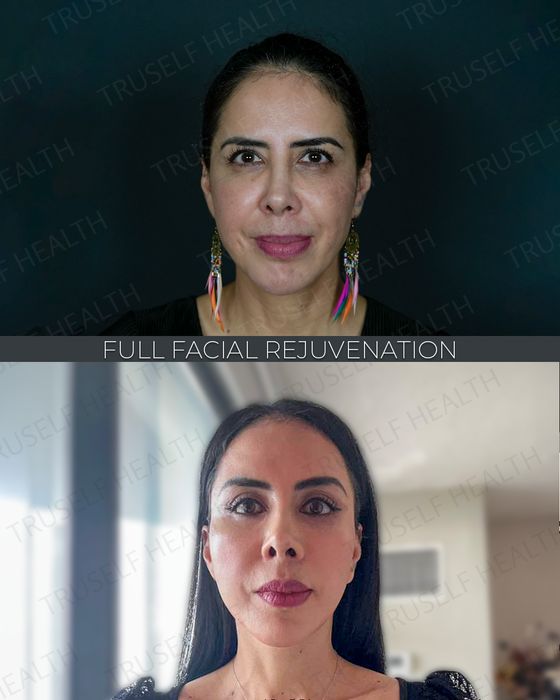 Facial Rejuvenation before and after