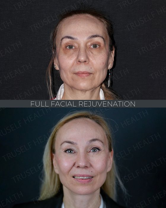 Facial Rejuvenation before and after