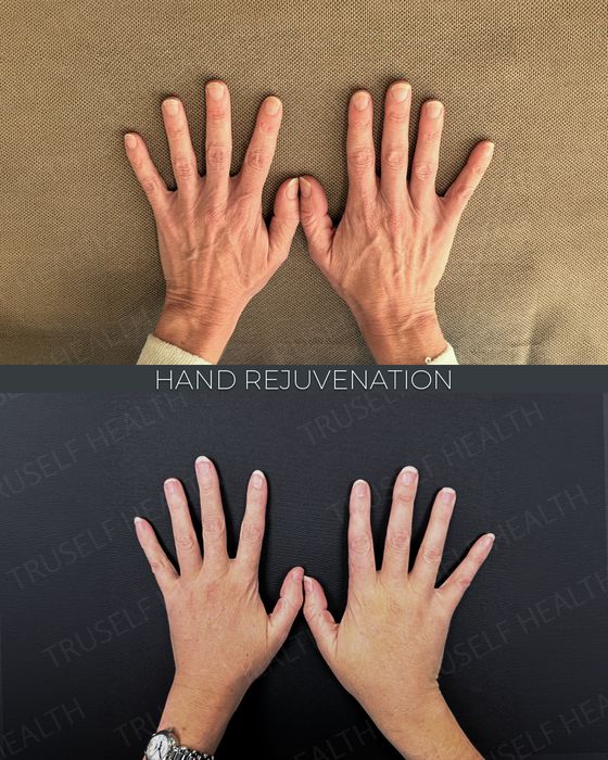Facial Rejuvenation before and after