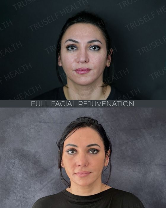 Facial Rejuvenation before and after