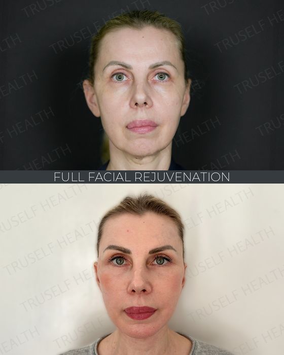 Facial Rejuvenation before and after