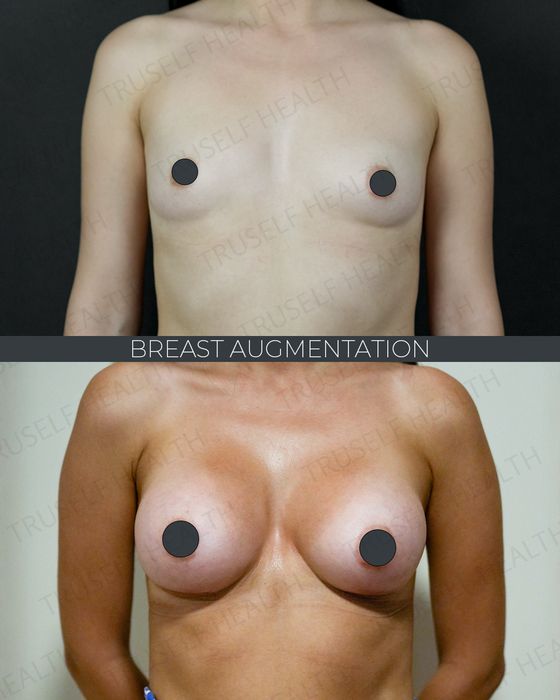 Facial Rejuvenation before and after