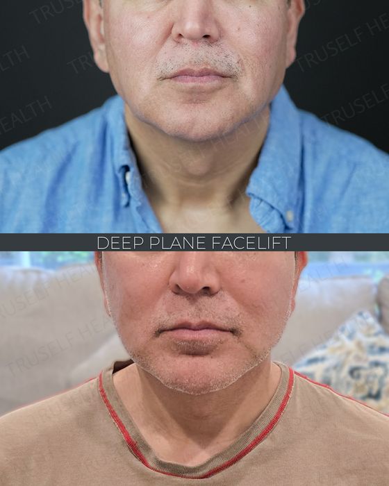 Facial Rejuvenation before and after