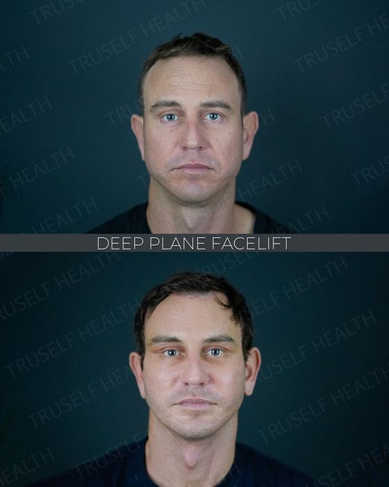 Jaw & Chin Surgery before and after