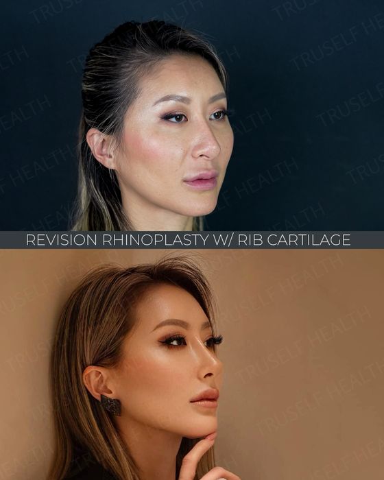 Rhinoplasty before and after