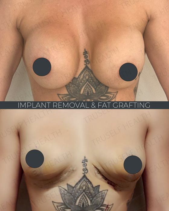 Breast Surgery before and after