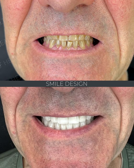 Smile Design before and after