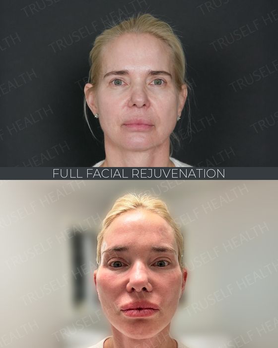 Facial Rejuvenation before and after