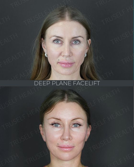Facial Rejuvenation before and after