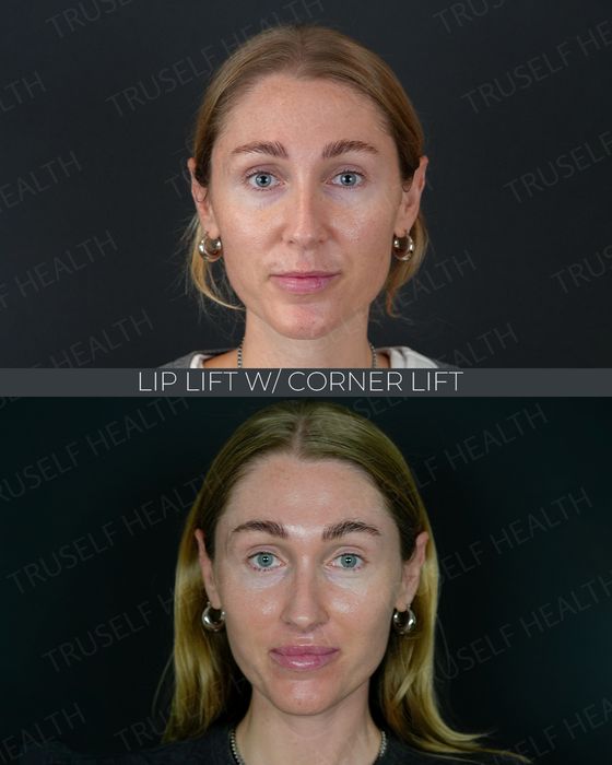 Facial Rejuvenation before and after