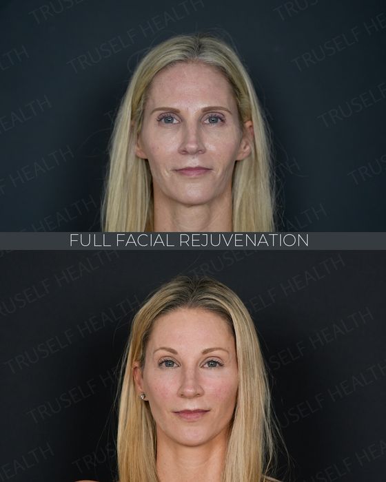 Facial Rejuvenation before and after