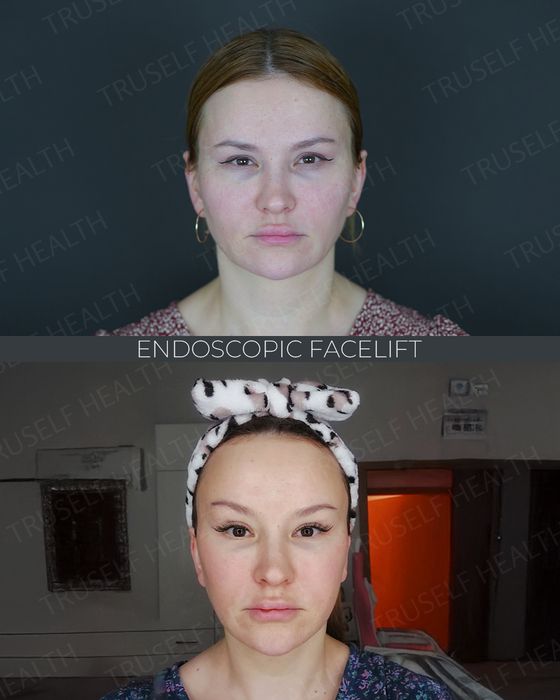 Facial Rejuvenation before and after