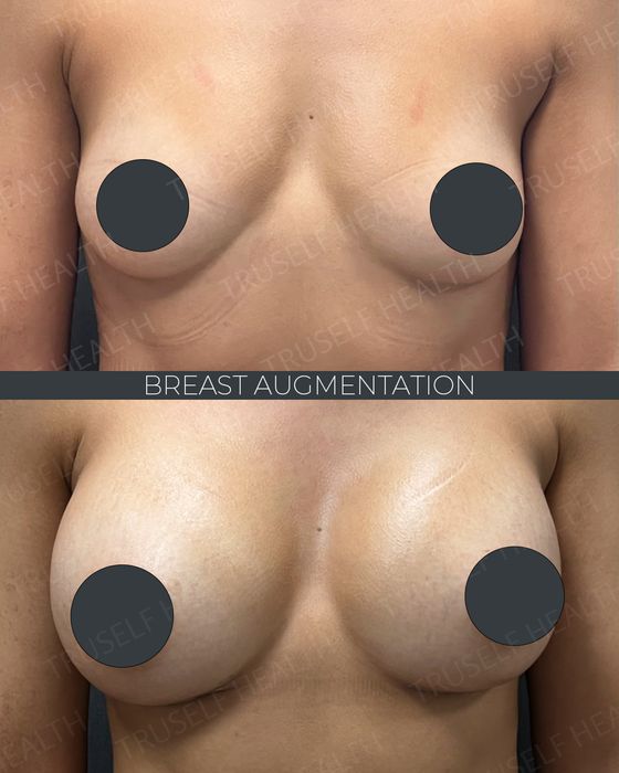 Breast Surgery before and after