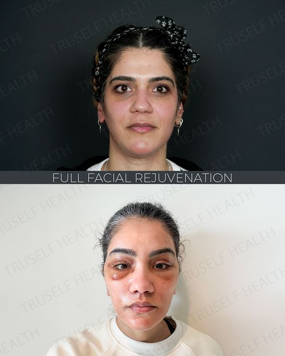 Facial Rejuvenation before and after