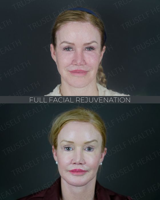 Facial Rejuvenation before and after