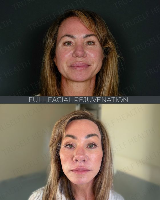 Facial Rejuvenation before and after
