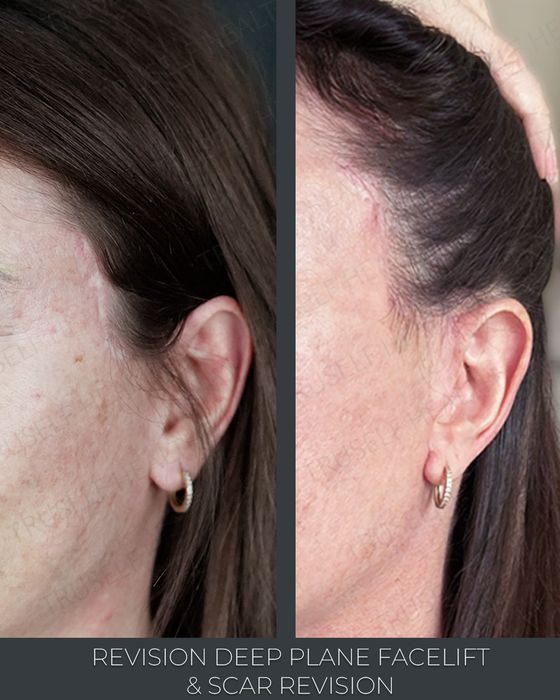 Facial Rejuvenation before and after