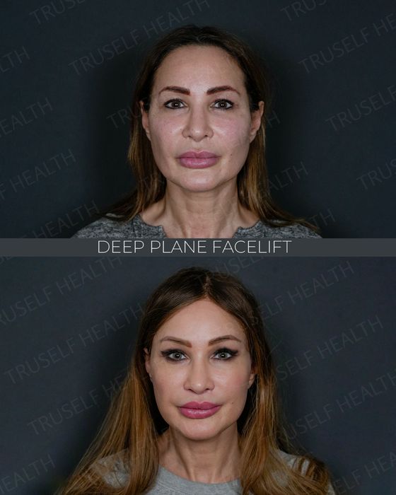 Facial Rejuvenation before and after
