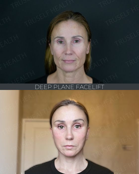 Facial Rejuvenation before and after