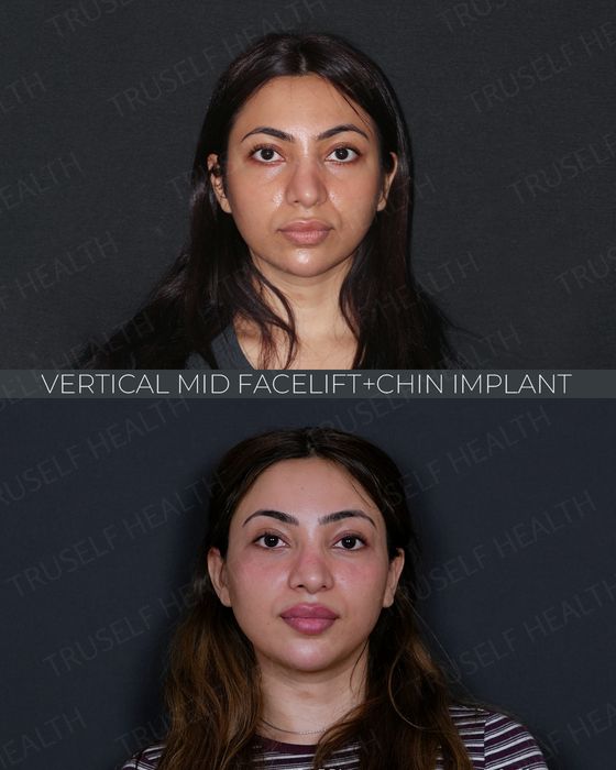 Facial Rejuvenation before and after