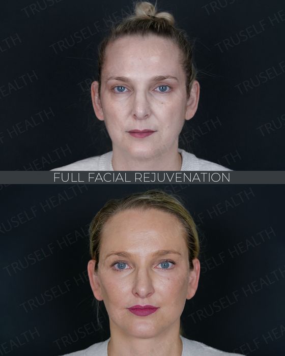 Facial Rejuvenation before and after