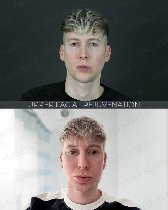 Eyelid & Brow before and after
