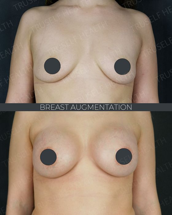 Breast Surgery before and after
