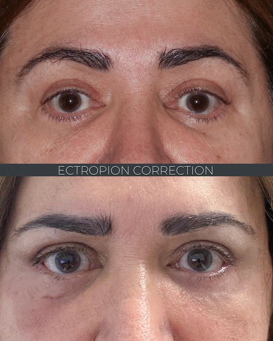 Facial Rejuvenation before and after
