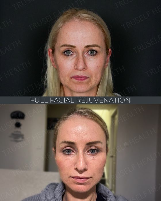 Facial Rejuvenation before and after