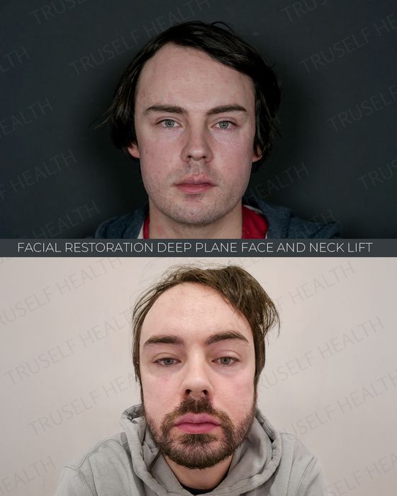 Facial Rejuvenation before and after