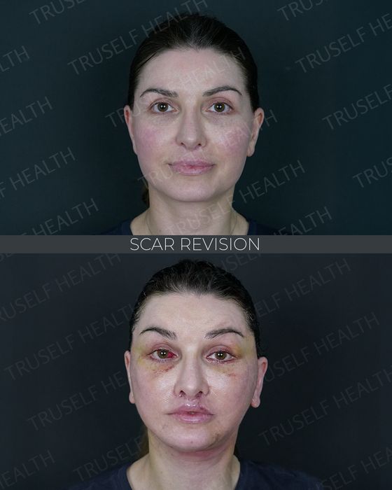 Facial Rejuvenation before and after