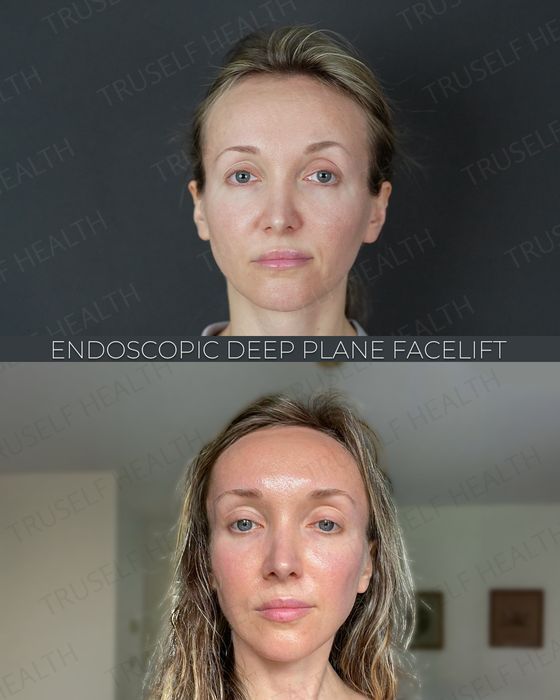 Facial Rejuvenation before and after
