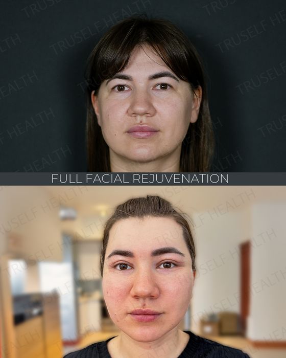 Facial Rejuvenation before and after