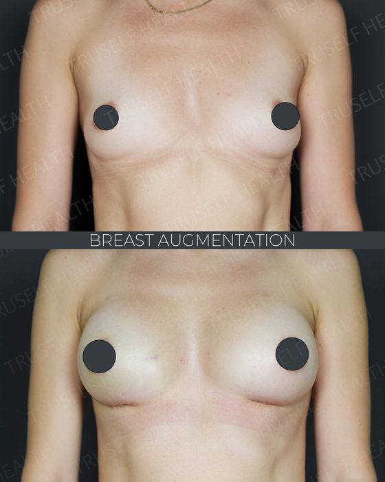 Breast Surgery before and after
