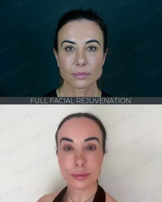 Facial Rejuvenation before and after