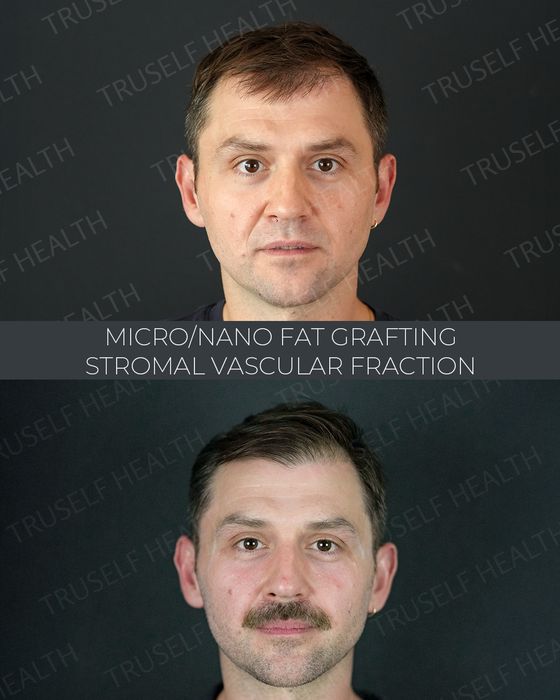 Facial Rejuvenation before and after