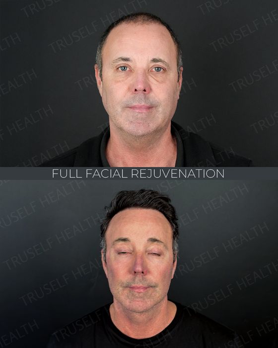 Facial Rejuvenation before and after