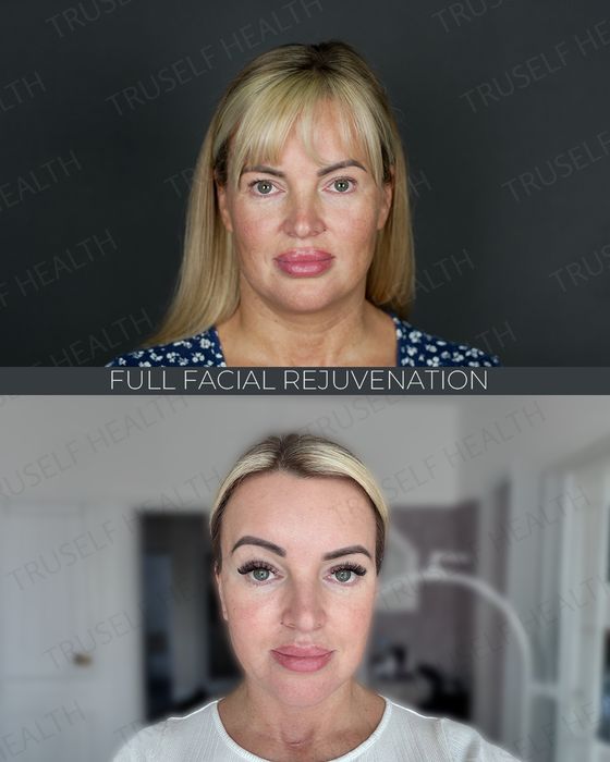 Facial Rejuvenation before and after