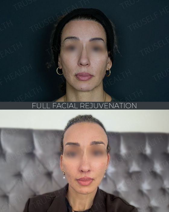 Facial Rejuvenation before and after