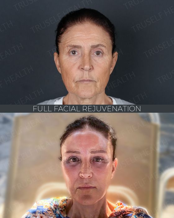 Facial Rejuvenation before and after