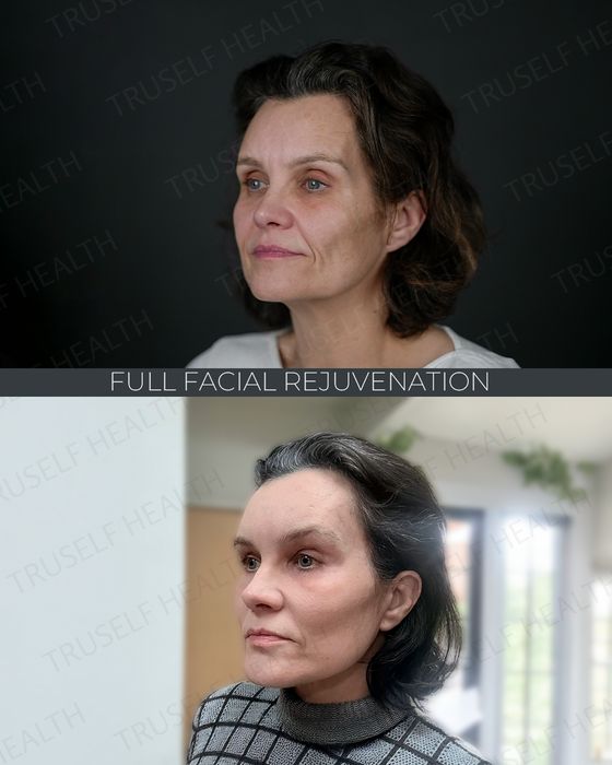 Facial Rejuvenation before and after