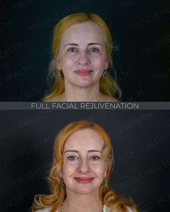 Facial Rejuvenation before and after